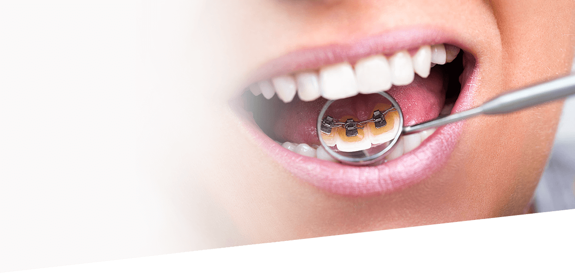 Incognito braces Incognito braces