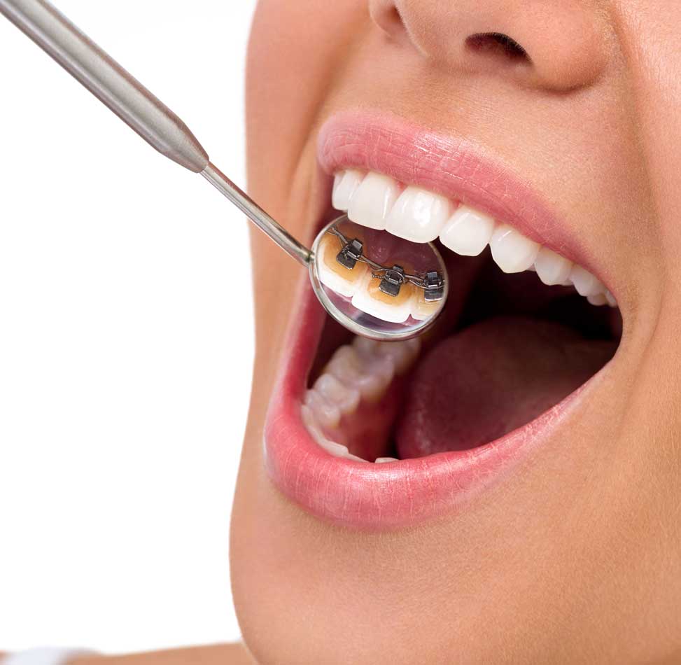 Invisible braces Invisible braces